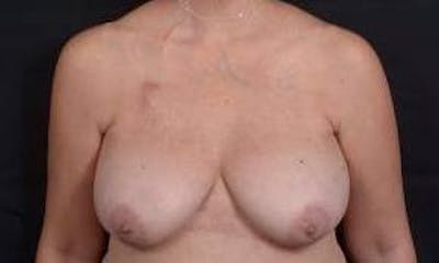 Immediate Breast Reconstruction – Skin Sparing Before & After Gallery - Patient 105579 - Image 1