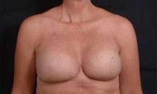 Immediate Breast Reconstruction – Skin Sparing Before & After Gallery - Patient 105579 - Image 2
