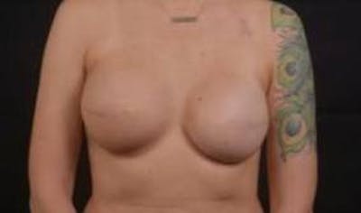 Immediate Breast Reconstruction – Skin Sparing Before & After Gallery - Patient 406784 - Image 2