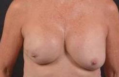 Immediate Breast Reconstruction – Skin Sparing Before & After Gallery - Patient 157047 - Image 1