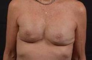 Immediate Breast Reconstruction – Skin Sparing Before & After Gallery - Patient 157047 - Image 2