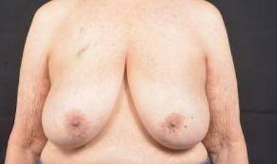 Immediate Breast Reconstruction – Skin Sparing Before & After Gallery - Patient 221455 - Image 1