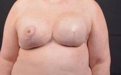 Immediate Breast Reconstruction – Skin Sparing Before & After Gallery - Patient 381662 - Image 2