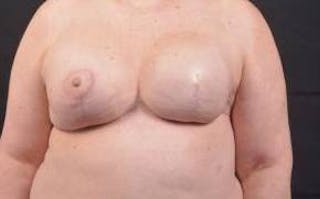 Immediate Breast Reconstruction – Skin Sparing Before & After Gallery - Patient 381662 - Image 2
