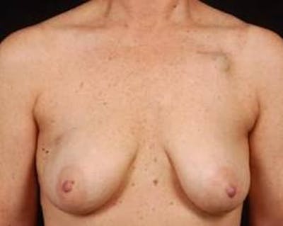 Immediate Breast Reconstruction – Skin Sparing Before & After Gallery - Patient 120845 - Image 1