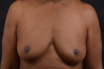 Immediate Breast Reconstruction – Skin Sparing Before & After Gallery - Patient 273184 - Image 1