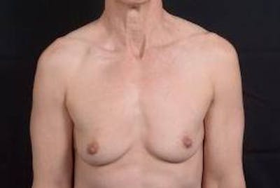 Immediate Breast Reconstruction – Skin Sparing Before & After Gallery - Patient 871817 - Image 1