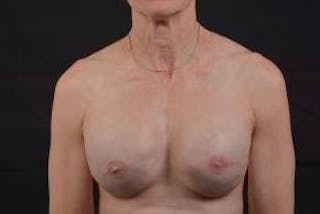 Immediate Breast Reconstruction – Skin Sparing Before & After Gallery - Patient 871817 - Image 2