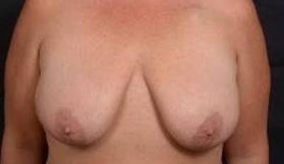 Immediate Breast Reconstruction – Skin Sparing Before & After Gallery - Patient 252977 - Image 1