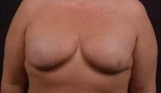 Immediate Breast Reconstruction – Skin Sparing Before & After Gallery - Patient 252977 - Image 2