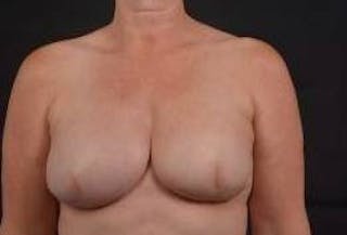 Immediate Breast Reconstruction – Skin Sparing Before & After Gallery - Patient 650936 - Image 2
