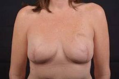 Immediate Breast Reconstruction – Skin Sparing Before & After Gallery - Patient 621368 - Image 2