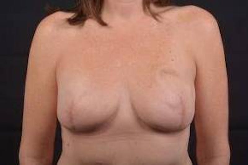 Immediate Breast Reconstruction – Skin Sparing Before & After Gallery - Patient 621368 - Image 2