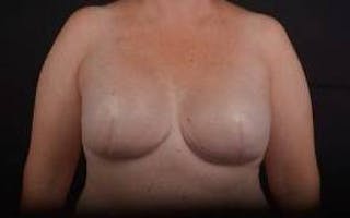 Immediate Breast Reconstruction – Skin Sparing Before & After Gallery - Patient 319356 - Image 2