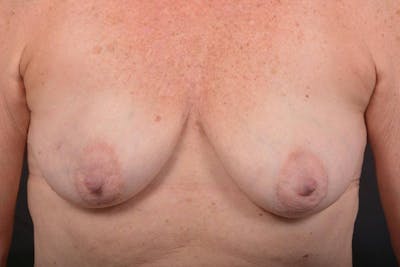 Immediate Breast Reconstruction – Skin Sparing Before & After Gallery - Patient 395325 - Image 1