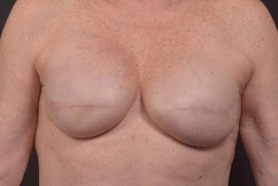 Immediate Breast Reconstruction – Skin Sparing Before & After Gallery - Patient 395325 - Image 2