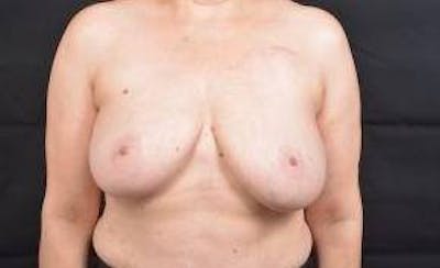 Immediate Breast Reconstruction – Skin Sparing Before & After Gallery - Patient 260184 - Image 1
