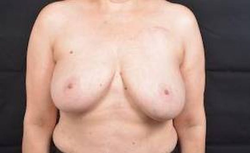 Immediate Breast Reconstruction – Skin Sparing Before & After Gallery - Patient 260184 - Image 1