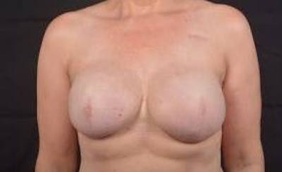 Immediate Breast Reconstruction – Skin Sparing Before & After Gallery - Patient 260184 - Image 2