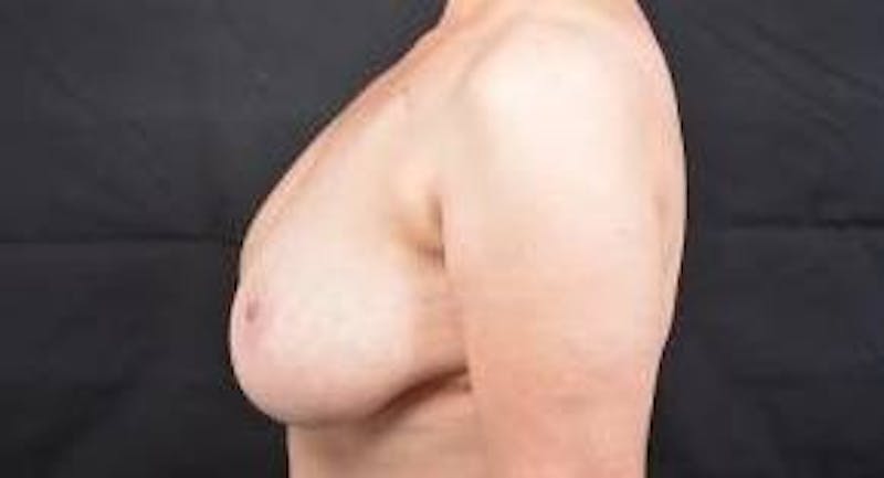 Immediate Breast Reconstruction – Skin Sparing Before & After Gallery - Patient 260184 - Image 3