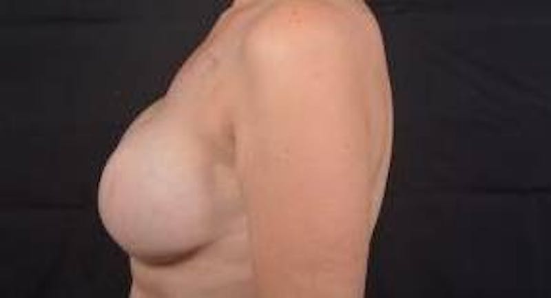 Immediate Breast Reconstruction – Skin Sparing Before & After Gallery - Patient 260184 - Image 4