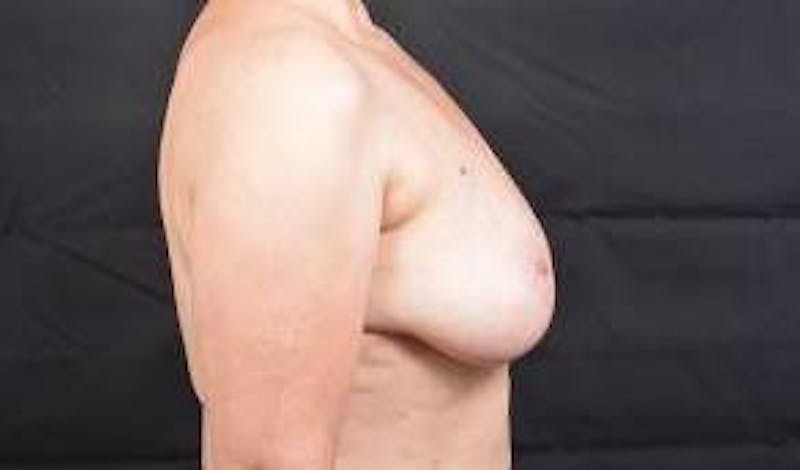 Immediate Breast Reconstruction – Skin Sparing Before & After Gallery - Patient 260184 - Image 5