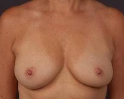 Prophylactic Mastectomy Before & After Gallery - Patient 198563 - Image 1