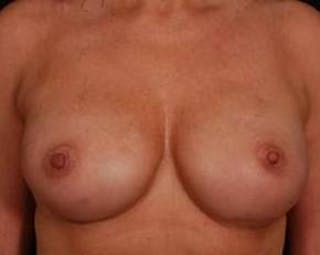 Prophylactic Mastectomy Before & After Gallery - Patient 198563 - Image 2