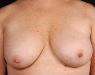 Prophylactic Mastectomy Before & After Gallery - Patient 282604 - Image 1