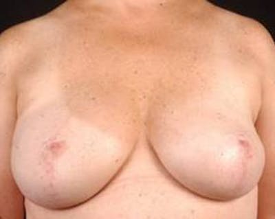 Prophylactic Mastectomy Before & After Gallery - Patient 282604 - Image 2