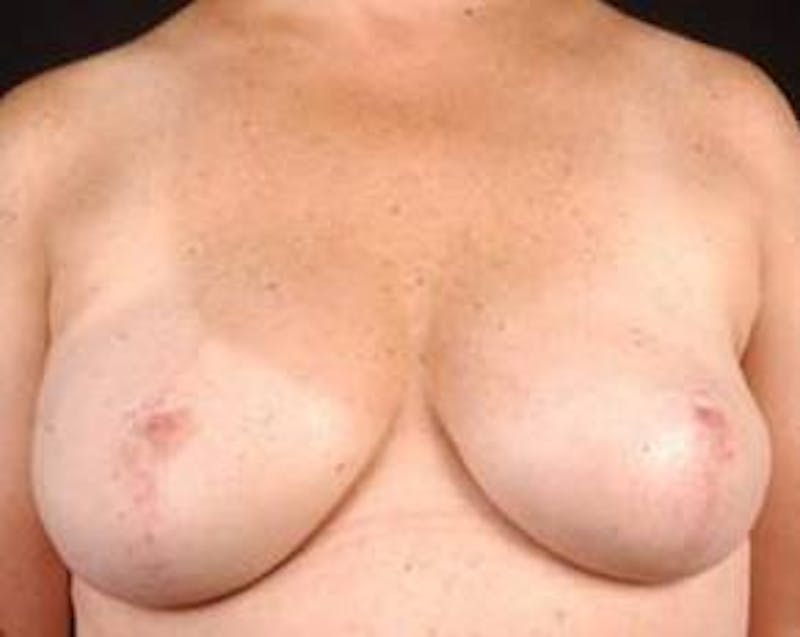 Prophylactic Mastectomy Before & After Gallery - Patient 282604 - Image 2