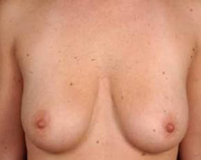 Prophylactic Mastectomy Before & After Gallery - Patient 252516 - Image 1