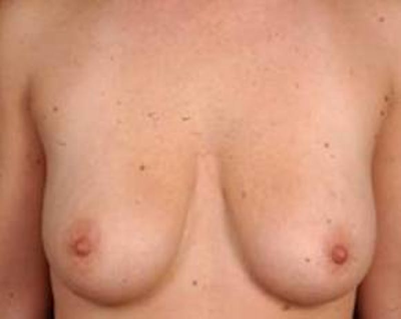 Prophylactic Mastectomy Before & After Gallery - Patient 252516 - Image 1
