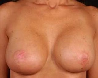 Prophylactic Mastectomy Before & After Gallery - Patient 252516 - Image 2