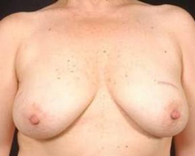 Prophylactic Mastectomy Before & After Gallery - Patient 412231 - Image 1