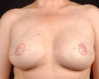 Prophylactic Mastectomy Before & After Gallery - Patient 412231 - Image 2