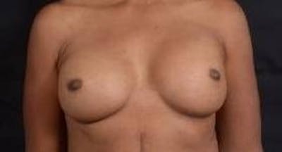 Reconstructive Breast Revision Before & After Gallery - Patient 407119 - Image 1