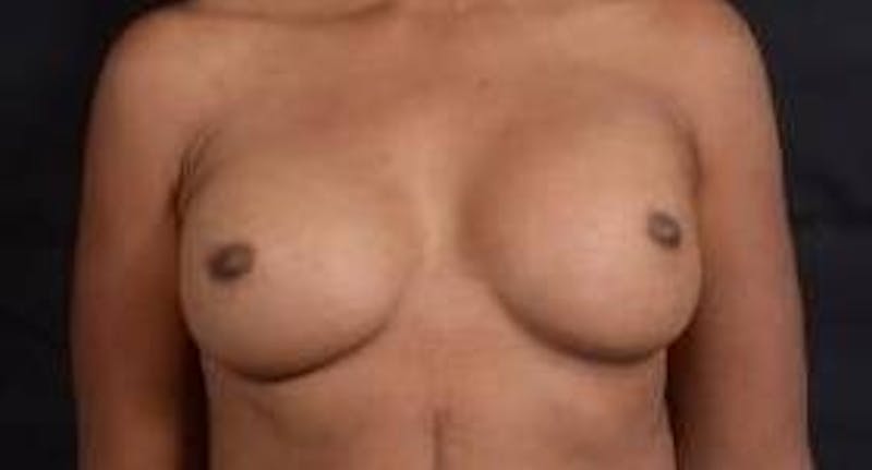 Reconstructive Breast Revision Before & After Gallery - Patient 407119 - Image 1