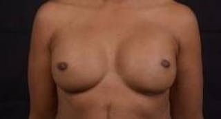 Reconstructive Breast Revision Before & After Gallery - Patient 407119 - Image 2