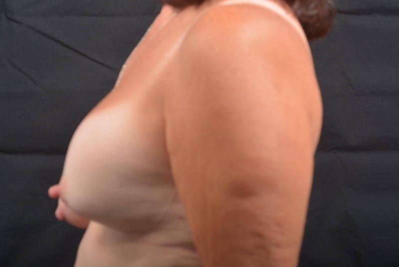 Reconstructive Breast Revision Before & After Gallery - Patient 399587 - Image 3