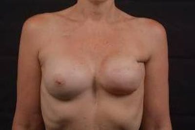 Reconstructive Breast Revision Before & After Gallery - Patient 420044 - Image 1