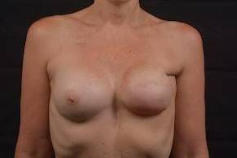 Reconstructive Breast Revision Before & After Gallery - Patient 420044 - Image 1