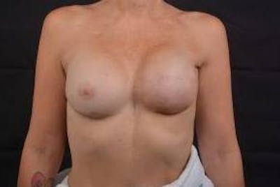 Reconstructive Breast Revision Before & After Gallery - Patient 420044 - Image 2