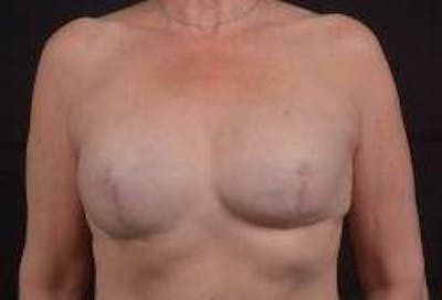 Reconstructive Breast Revision Before & After Gallery - Patient 348145 - Image 1