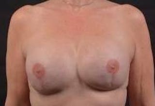 Reconstructive Breast Revision Before & After Gallery - Patient 348145 - Image 2