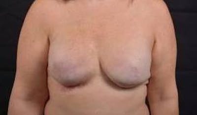 Reconstructive Breast Revision Before & After Gallery - Patient 723730 - Image 1