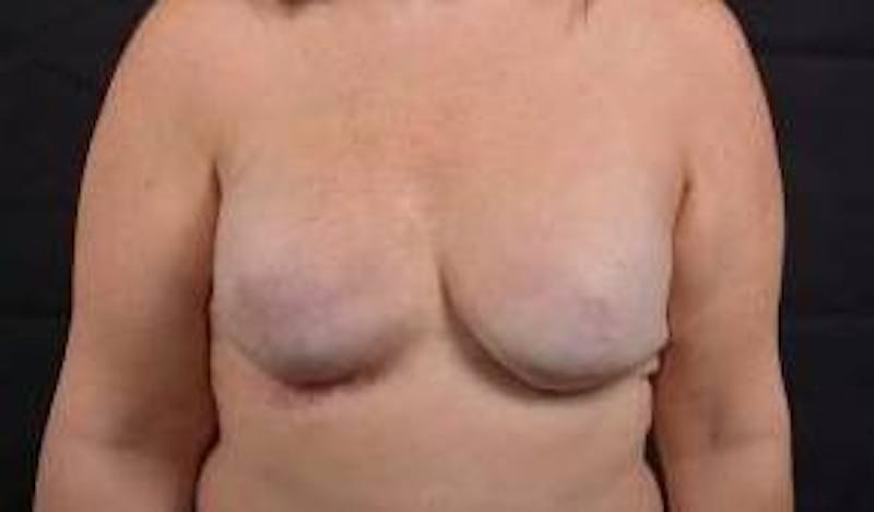 Reconstructive Breast Revision Before & After Gallery - Patient 723730 - Image 1