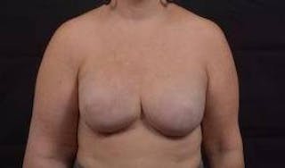 Reconstructive Breast Revision Before & After Gallery - Patient 723730 - Image 2
