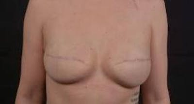 Reconstructive Breast Revision Before & After Gallery - Patient 137861 - Image 1