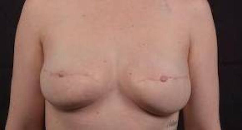 Reconstructive Breast Revision Before & After Gallery - Patient 137861 - Image 2
